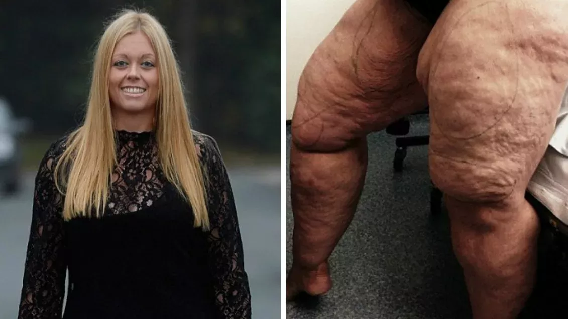 Weil sie an einer seltenen Krankheit leidet, lässt sie sich 12 Liter Fett in den Beinen absaugen.
