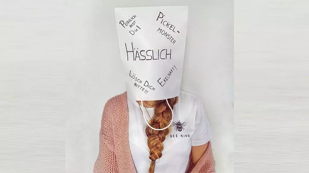 Hanna Bohnekamp steht zu ihrer Akne