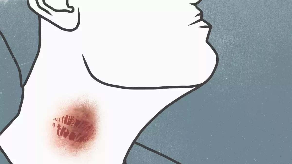 Knutschflecken: Expert:in warnt vor tödlichem Schlaganfall