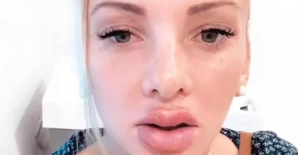 Ex-Bachelor-Kandidatin: Nach OP platzen ihr die Lippen auf