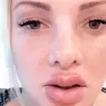 Ex-Bachelor-Kandidatin: Nach OP platzen ihr die Lippen auf