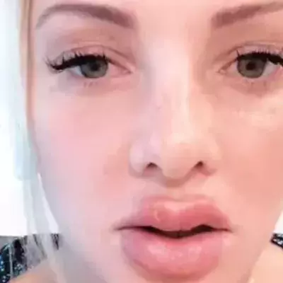 Ex-Bachelor-Kandidatin: Nach OP platzen ihr die Lippen auf